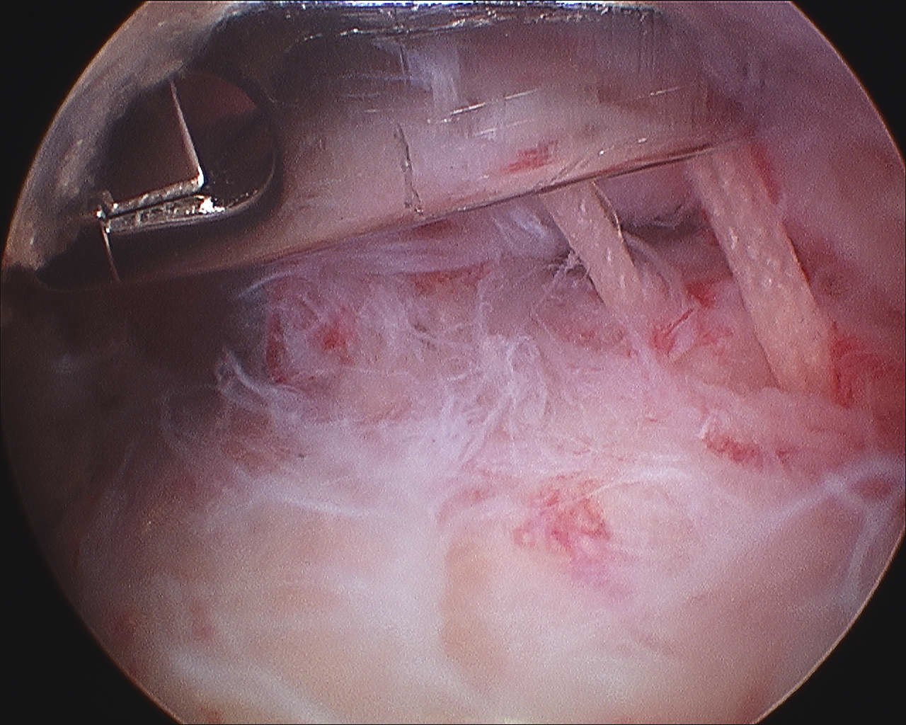 Shoulder PASTA Repair Sutures in Subacromial Space
